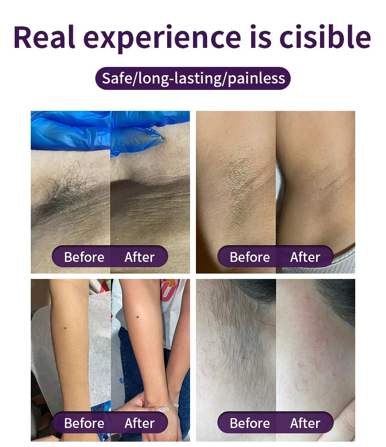 Medical CE Certified 4 Wavelength 755nm/940nm/1064nm/808nm Skin Rejuvenation Hair Removal High Diode Laser Hair Removal Machine