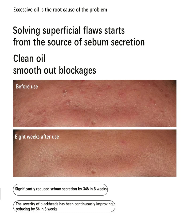 Niacinamide 10% + Zinc 1% Serum 30ml Control Oil Remove Acne and Brighten Oily Skin Gentle Exfoliating Closed-mouth...