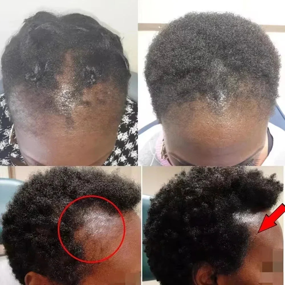 Fast Hair Growth Set Batana Oil Traction Alopecia Hair Mask Anti Break Loss Hair Growth Oil Baldness Treatment Hair...