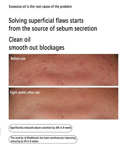 Niacinamide 10% + Zinc 1% Serum 30ml Control Oil Remove Acne and Brighten Oily Skin Gentle Exfoliating Closed-mouth...