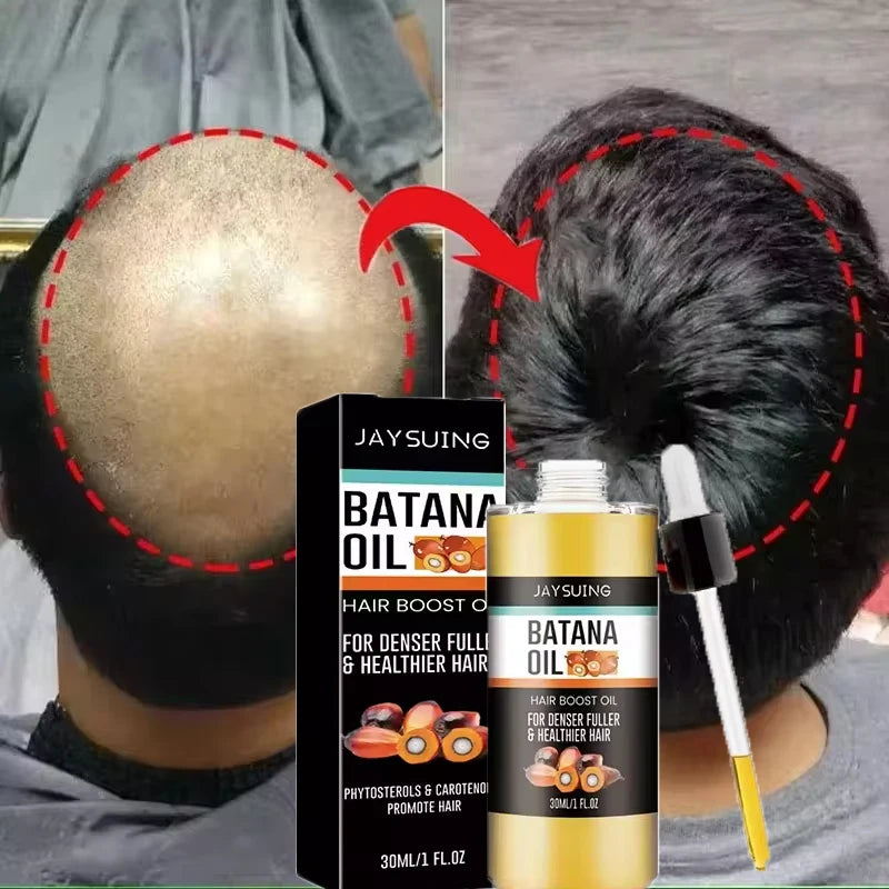 Fast Hair Growth Set Batana Oil Traction Alopecia Hair Mask Anti Break Loss Hair Growth Oil Baldness Treatment Hair...