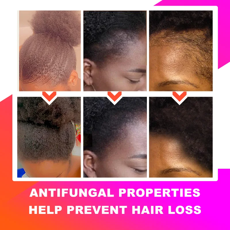 Sevich 30ml Africa Traction Alopecia Chebe Hair Oil Crazy Thicken Fast Hair Growing Oil Anti-Hair Loss Wildly Grow Long Hair