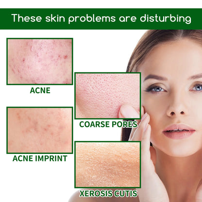 Salicylic Acid Anti Acn-e Face Serum Hydrating Fader Acne Mark Pimple Blackhead Removal Shrink Pores Oil Control Facial...