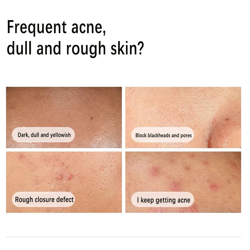Niacinamide 10% + Zinc 1% Serum 30ml Control Oil Remove Acne and Brighten Oily Skin Gentle Exfoliating Closed-mouth...